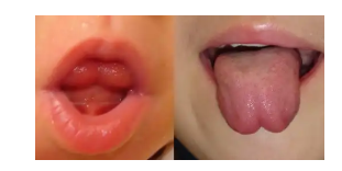 舌小帯短縮症の症例写真(舌を出した比較)